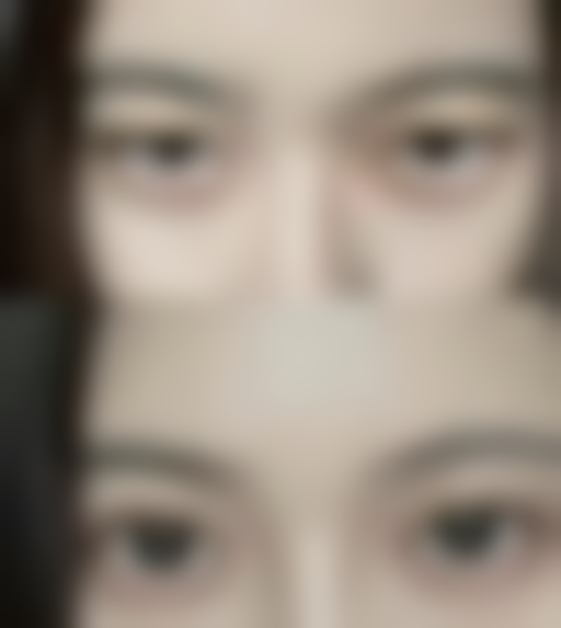 南通英莎医美【全切双眼皮与眼袋外切二选一特别优惠 10000】手术风险与应对