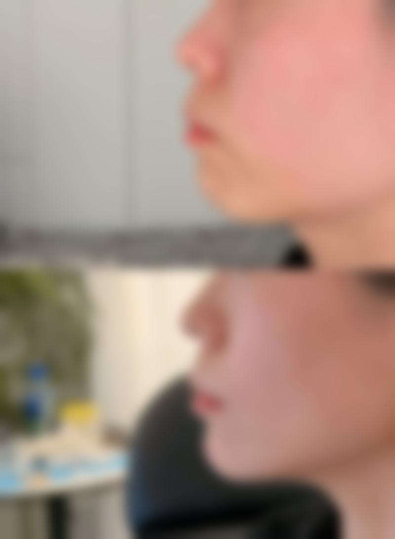 新生儿多久单眼皮变双眼皮之营养状况:吃出来的“电眼”潜力