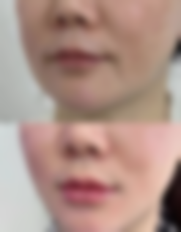 做完眼袋出现疤痕增生可以下去吗？内切外切恢复时间大不同，激光药物帮你加速淡化！