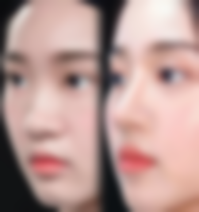 硅胶假体隆胸保存年限之进口与国产差异