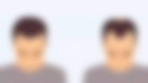 隆胸以后会有什么危害：包膜挛缩变硬——当乳房变成“石头”