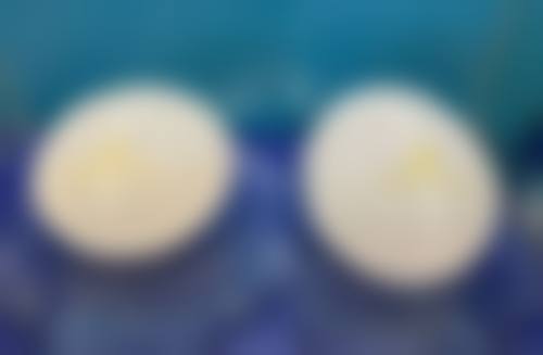 疤痕体质增生怎么治疗:环钻切除手术的效率高治疗