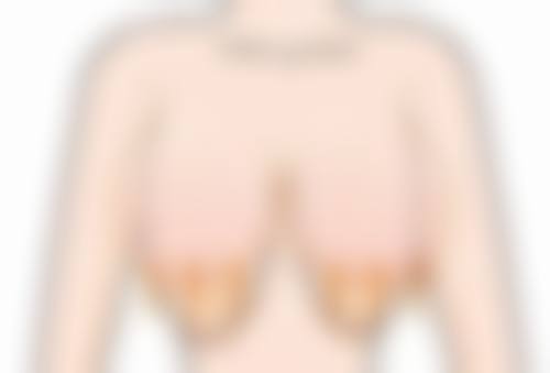 总结：小腿肚抽脂，值得吗？