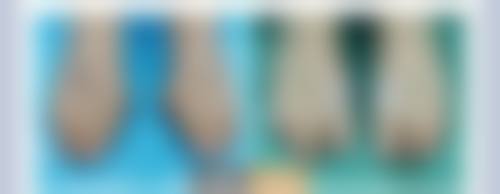 隆胸傲诺拉假体好吗——轻松修复的美丽之旅