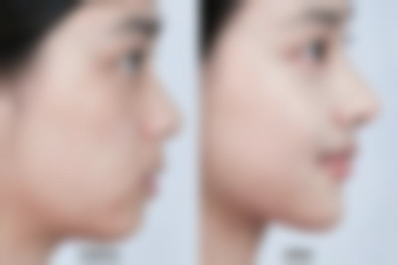 疤痕增生如何医治？三甲医院推荐硅酮凝胶+激光联合治疗，整形医院手术修复更精准