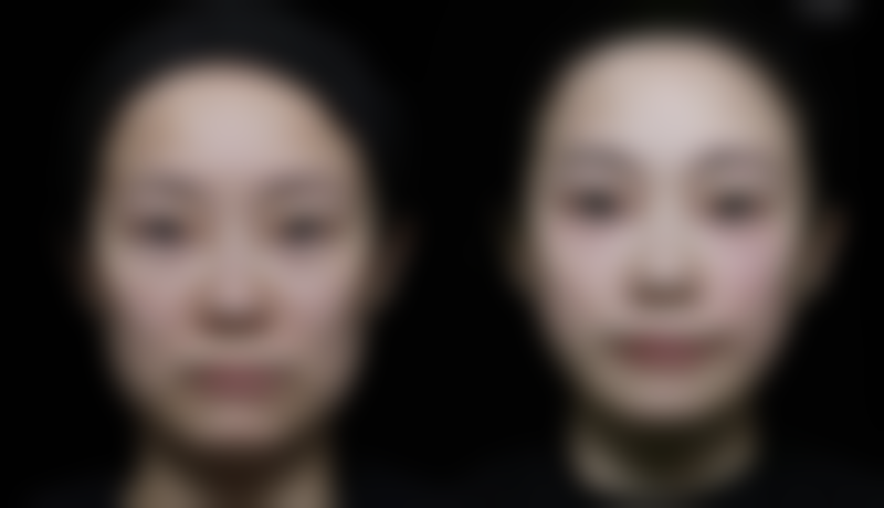 小腿肚可以抽脂吗：术后护理全流程指南