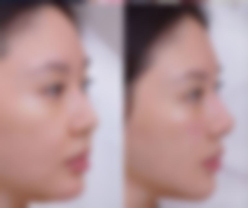 隆胸傲诺拉假体好吗？安全自然又持久，璀璨系列真实测评来啦