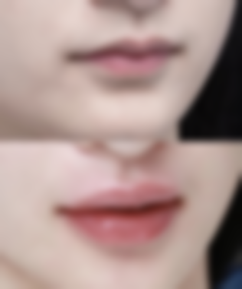 皮肤专科医院:精细评估与个性化方案治疗疤痕增生