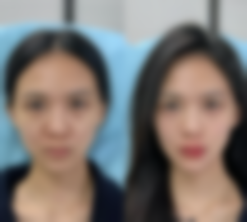 隆胸傲诺拉假体好吗——价格背后的价值考量