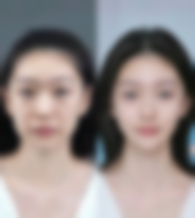 臀部吸脂减肥疼吗？北京医院专家揭秘术后护理关键点，轻松度过恢复期