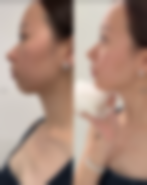 假体隆胸喂奶会下垂吗之哺乳习惯的作用