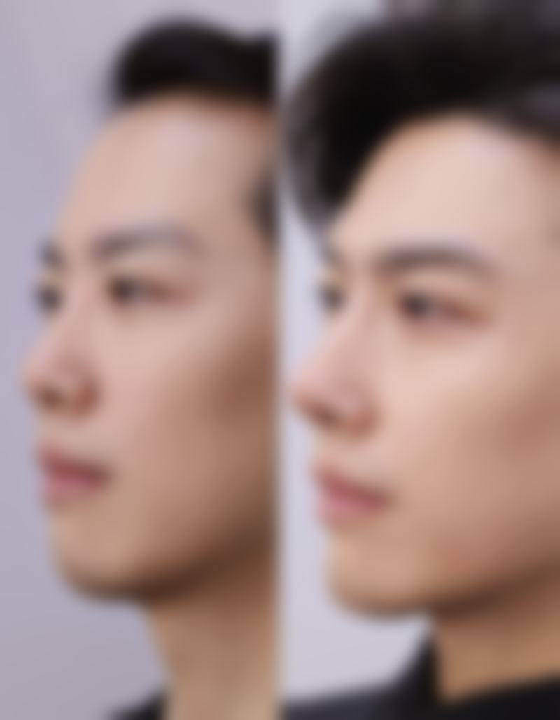 额头摔伤缝针的疤痕怎么去:手术修复,重度疤痕的终极解决方案