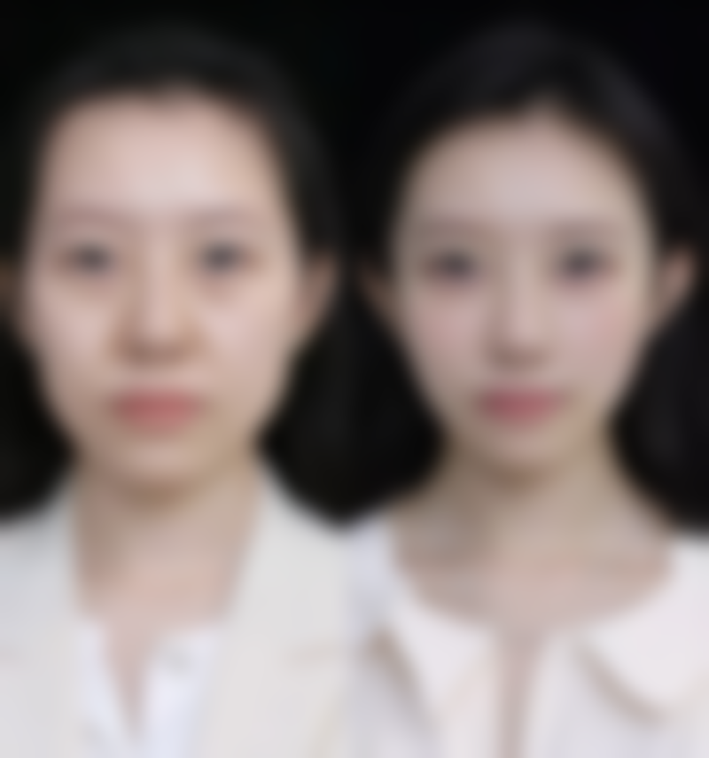 打瘦脸针打麻药吗:不同机构优缺点深度对比