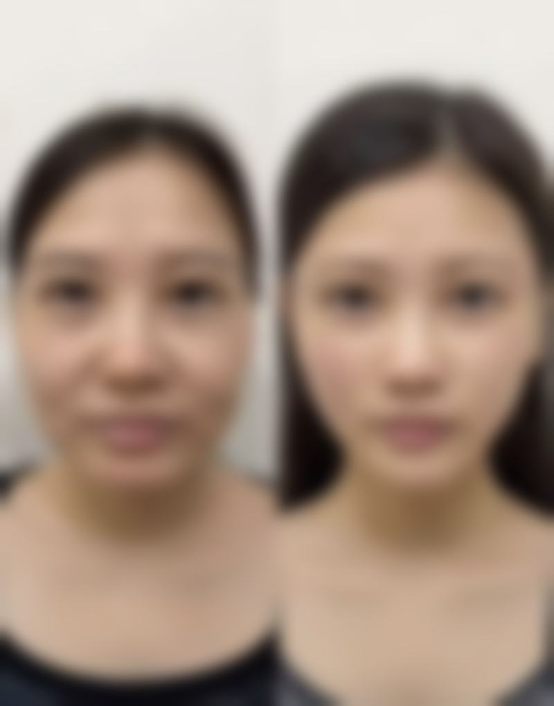 私立医院的瘦脸针剂量特点：精细大胆的尝试