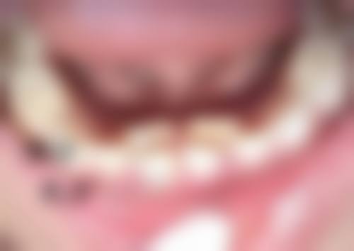 长期的下眼袋怎么去除——运动：面部“健身教练”