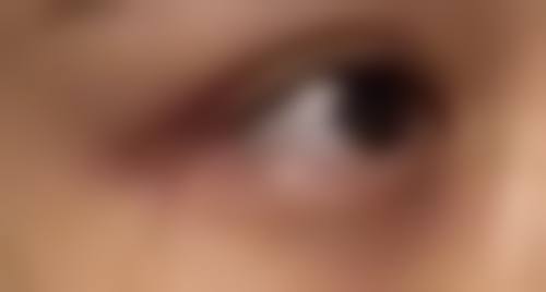 抽脂后多久能不疼：何时需要就医