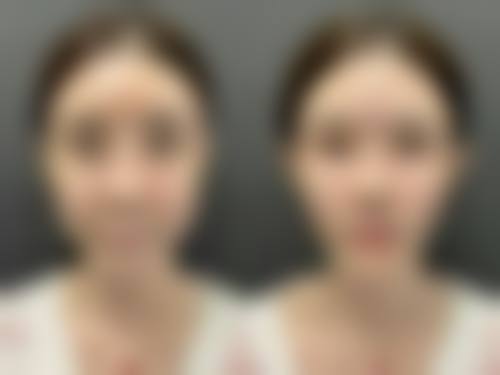 瘦脸针不能吃什么消炎药之青霉素类：需要警惕