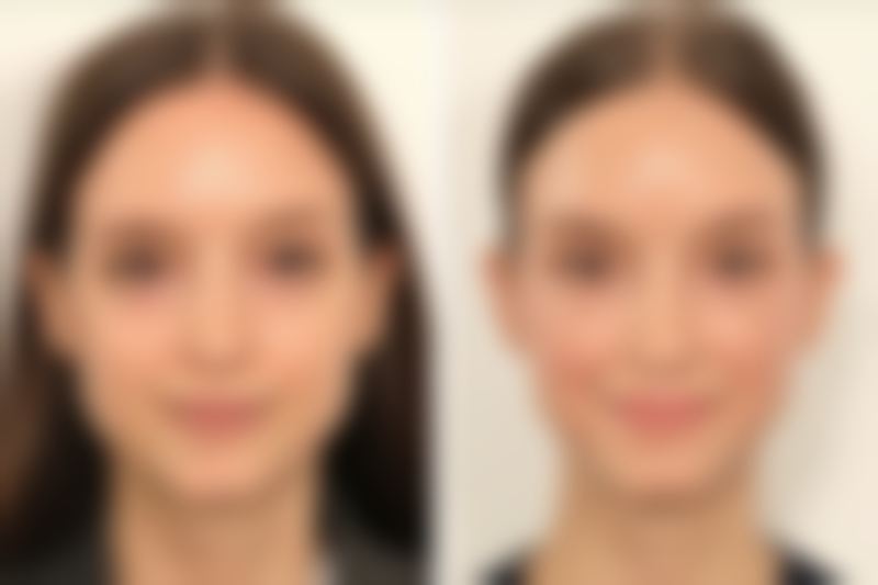 去除黑眼袋用什么按摩手法：辅助护理的有效手段