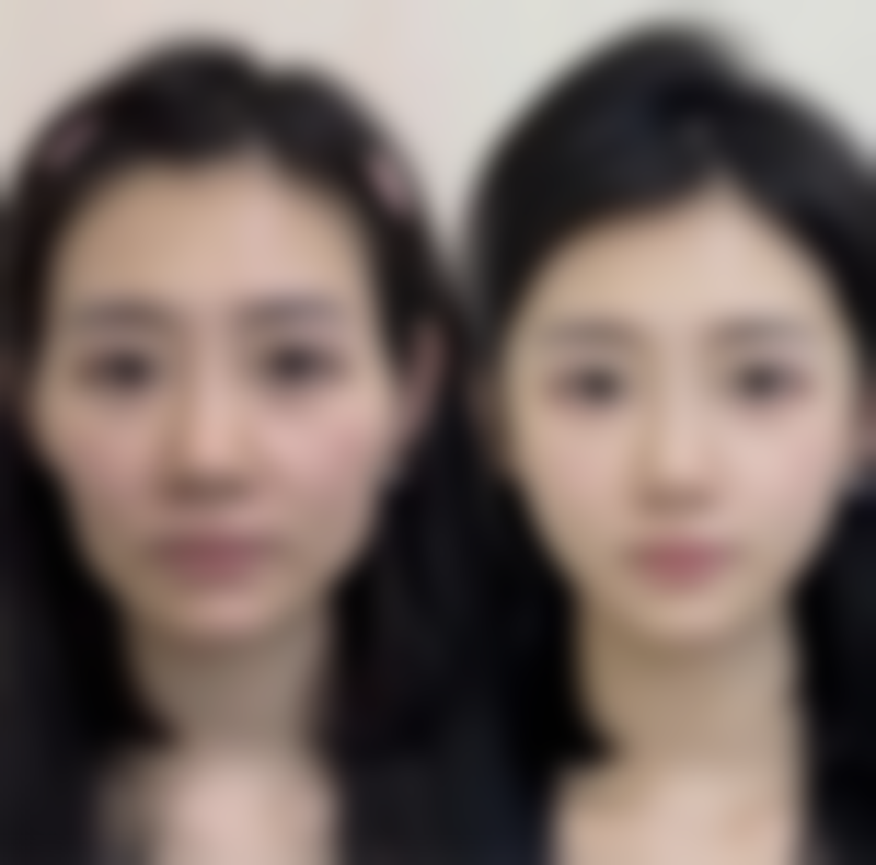 长期的下眼袋怎么去除？手术+眼霜双管齐下，激光与按摩长期护理方案