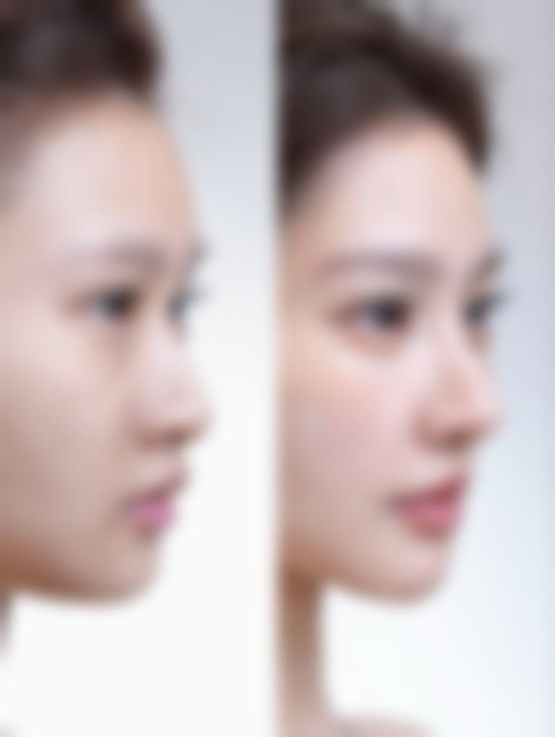 黑眼圈和眼袋怎去除，医生推荐4个按摩动作+激光手术双管齐下