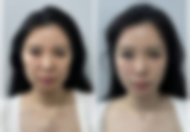 胸前长痘痘有疤痕疙瘩:联合治疗成效加倍