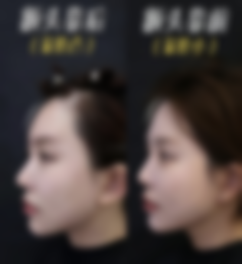 尾段:告别疤痕,重拾自信