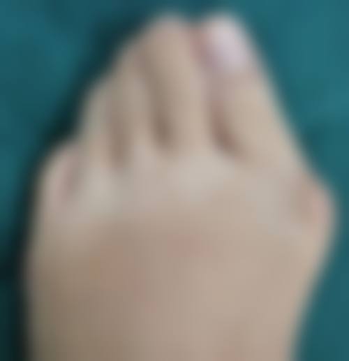 国字脸打瘦脸针:咬肌肥大型的福音?