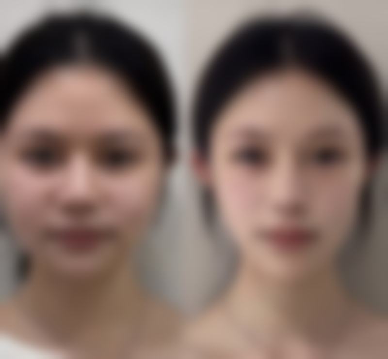 抽脂隆胸对生育功能有害吗——未来妈妈的美丽选择题