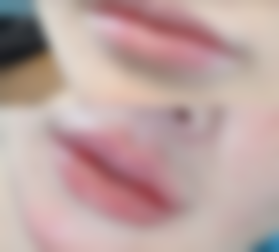 全切双眼皮修复之医生选择的关键指标