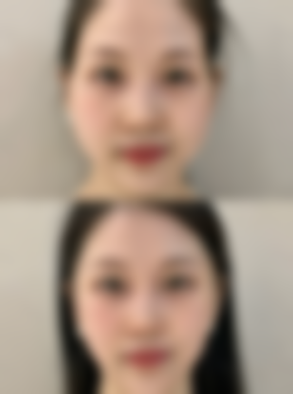 激光疤痕如何快速修复，点阵激光+术后护理双管齐下告别痘坑