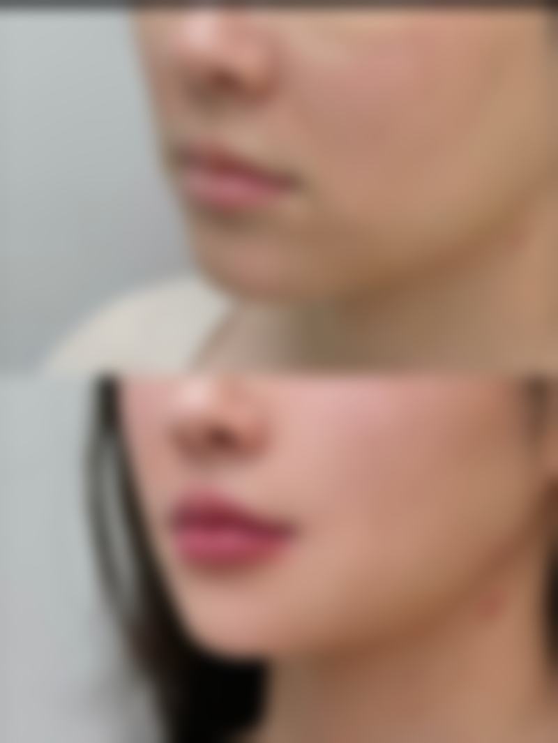 广州的埋线全切双眼皮医院：个性化服务成就美丽梦想