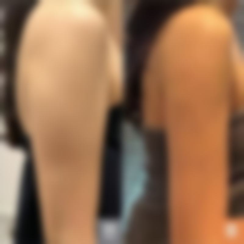 埋线全切双眼皮术后修复小贴士：精心护理成就美丽蜕变