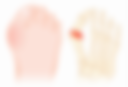 药水点痣疤痕增生的有效治疗方法