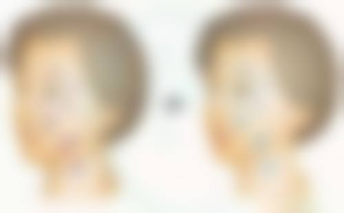 特殊类型疤痕的光电应对策略——增生性、凹陷性及儿童疤痕的精细处理