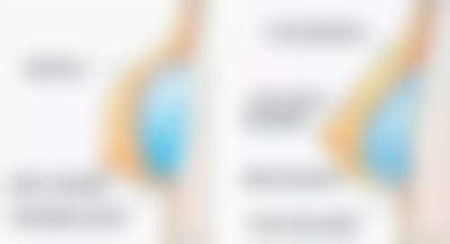 疤痕性痘痘怎么消除——饮食注意事项