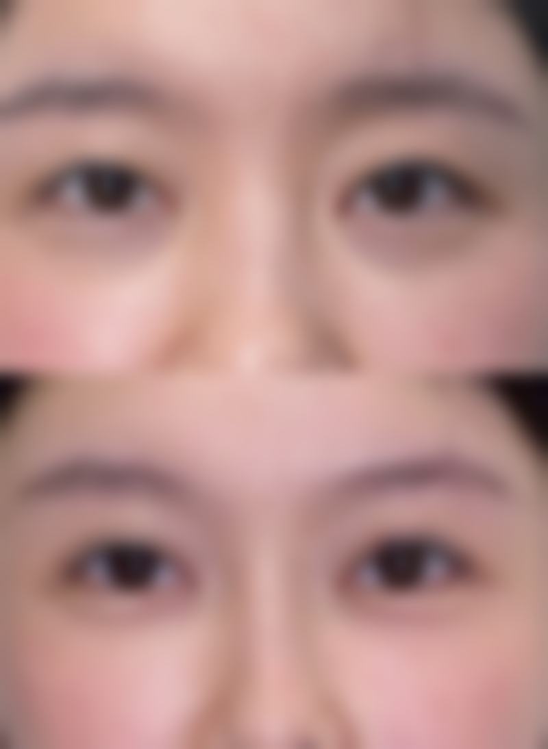 疤痕性痘痘怎么消除——医院推荐