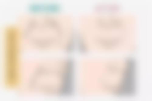 肚子抽脂后皮肤多久修复紧致——皮肤紧致：3 - 6个月的“塑形黄金期”