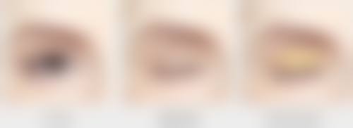 埋线双眼皮：午休变得更美的快捷之选，但非永恒之美