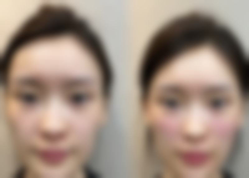 割双眼皮：一劳永逸的美丽蜕变，但需历经修复期考验