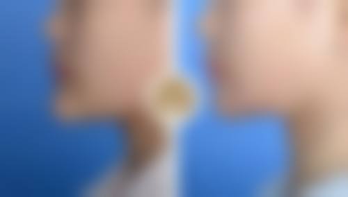 做阴道紧缩术后能顺产吗：阴道紧缩术后不能顺产的原因