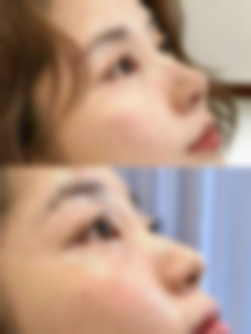 瘦脸针100u剂量含义大揭秘