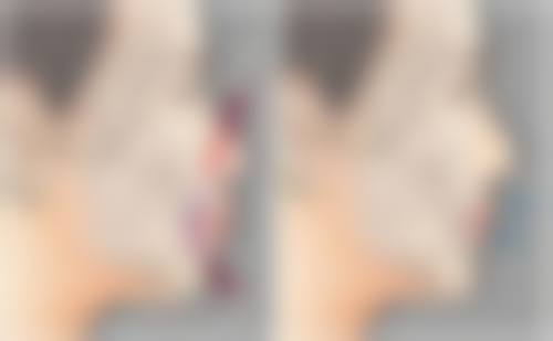 隆鼻硅胶膨体哪个好——持久度实测:10年后谁能屹立不倒