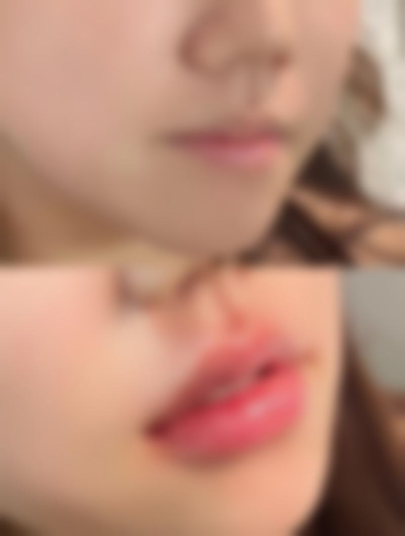 隆鼻硅胶膨体哪个好——价格大公开:从5千到3万的奥秘