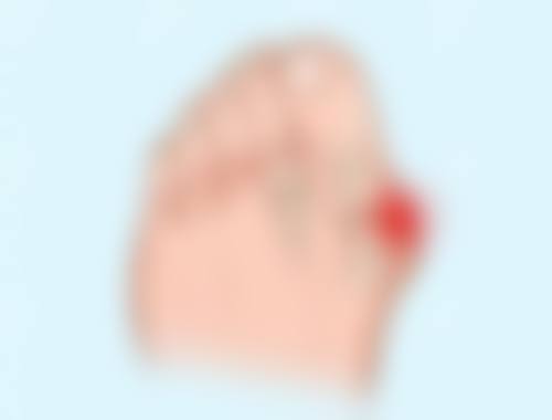 哪种隆鼻方式比较好：线提升隆鼻——微创提升，成效有限