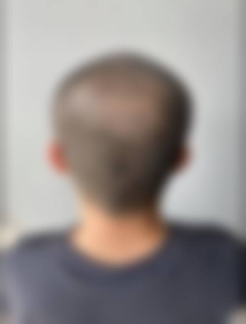 黄拔瑞医生做手术价格