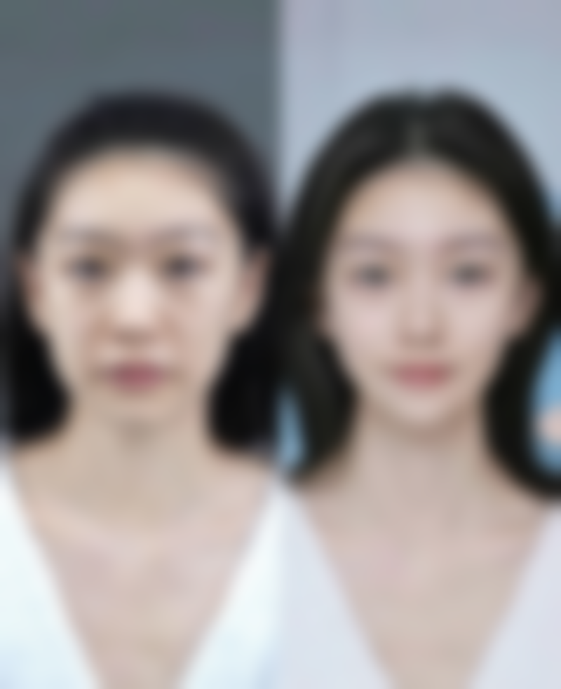 平行双眼皮适合杏仁眼型吗——杏仁眼与平行双眼皮，天生一对的精致之选