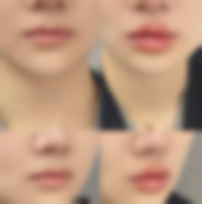 平行双眼皮适合桃花眼型吗——桃花眼与平行双眼皮，深情魅力的理想融合