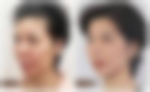 乳房大抽脂的手术原理是怎样的