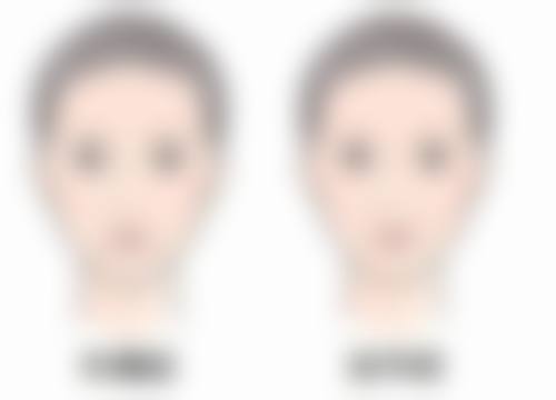 隆鼻线提升取出之原因大剖析