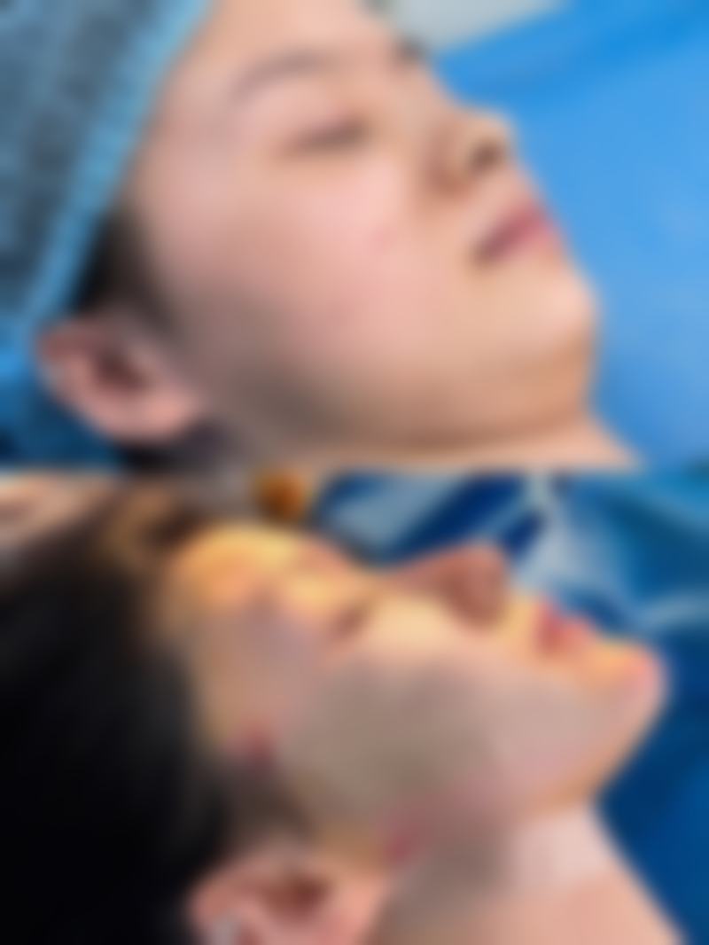 隆鼻线提升取出的至佳时机抉择